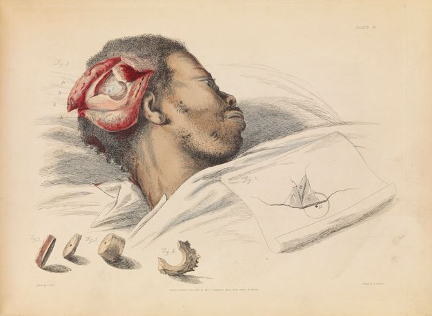 Illustration. A hand-coloured print shows a Black man’s face turned away from us. The skin of his skull has been cut and folded back. The bones within show the round cut of a trephine. Pieces of bone are drawn below. The original fracture is sketched on a piece of paper within the print.